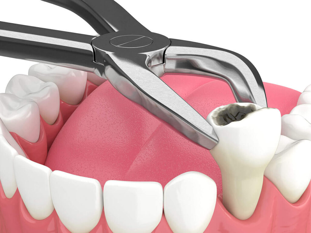 A 3D illustration of a tooth extraction process showing an upper premolar being removed with dental forceps, set against a white and pink background to depict oral surgery.